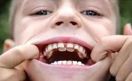 什么是双排牙？为什么长出双排牙？