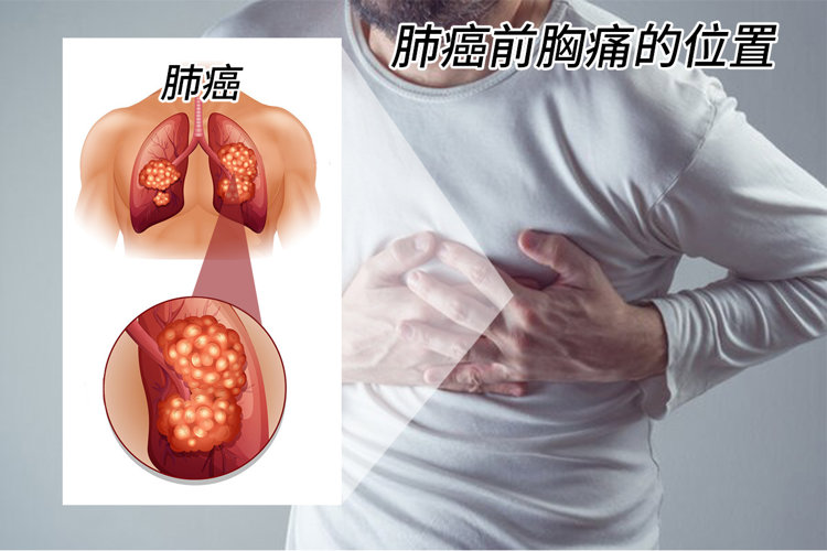 肩背疼半月，病根竟然出在肺里！提醒：肺癌初期症状，不只是咳嗽