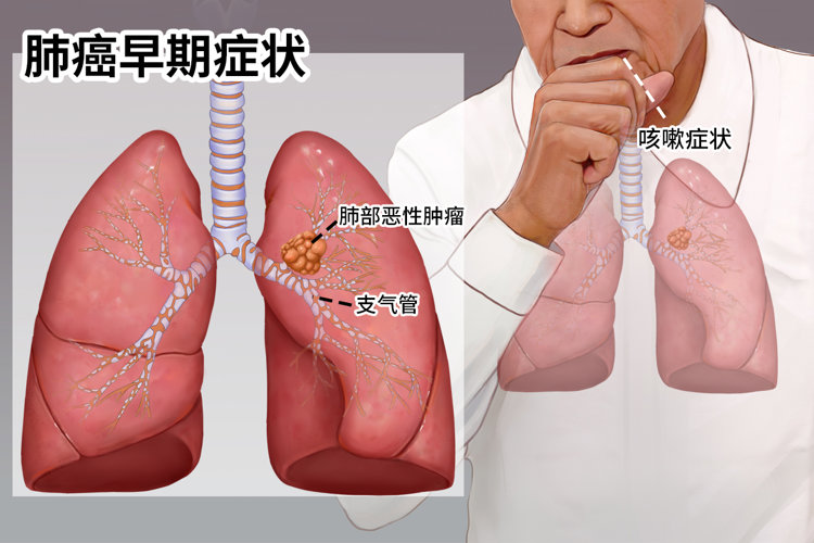 肩背疼半月，病根竟然出在肺里！提醒：肺癌初期症状，不只是咳嗽