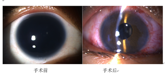 陈蔚教授的海南（博鳌）国际眼视光团队顺利完成30例人工虹膜植入术