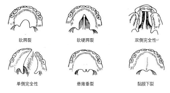 福州海峡免费援助3名唇腭裂人士,点击看周亚宽主任的手术实例