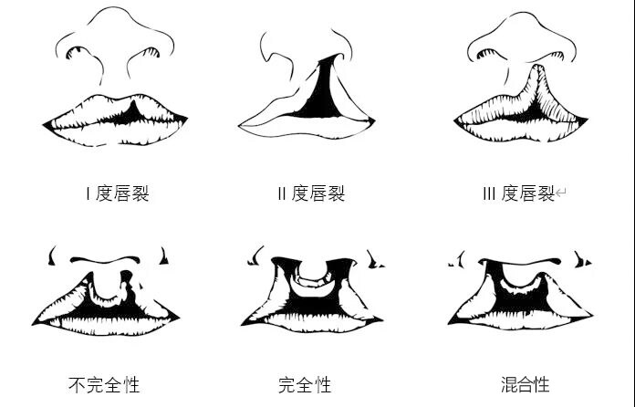 福州海峡免费援助3名唇腭裂人士,点击看周亚宽主任的手术实例