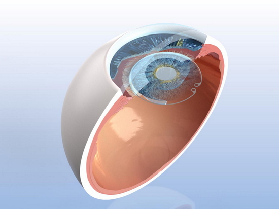 陈蔚教授的海南（博鳌）国际眼视光团队顺利完成30例人工虹膜植入术