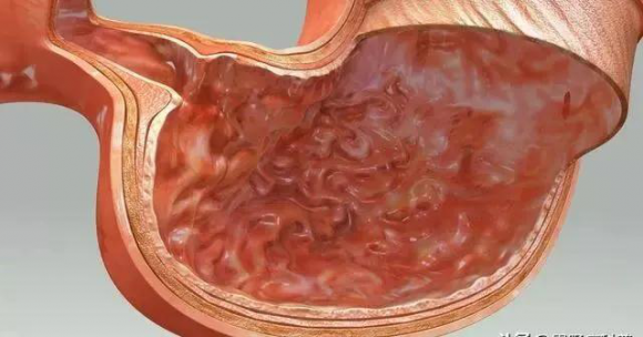 呼和浩特市东大肛肠医院 同是胃病，胃溃疡和胃糜烂哪个更严重？
