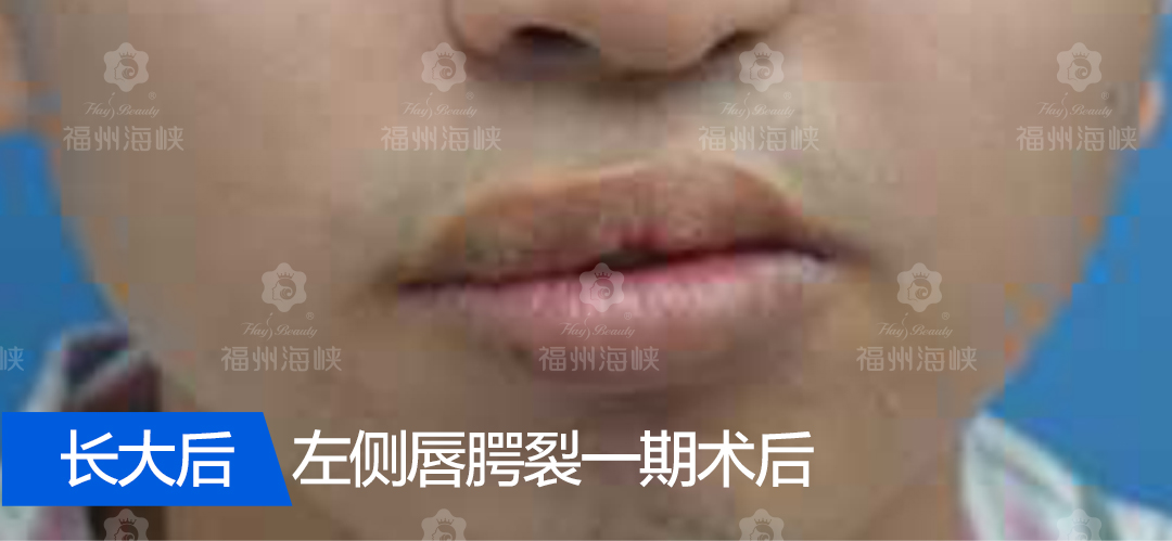 福州海峡免费援助3名唇腭裂人士,点击看周亚宽主任的手术实例