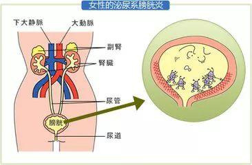 合川宏仁医院张振杨为你介绍膀胱炎的那些事!