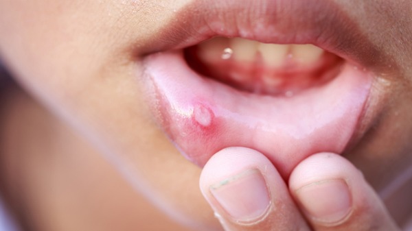 口腔溃疡吃什么药效果好？口腔溃疡是缺乏哪种维生素？