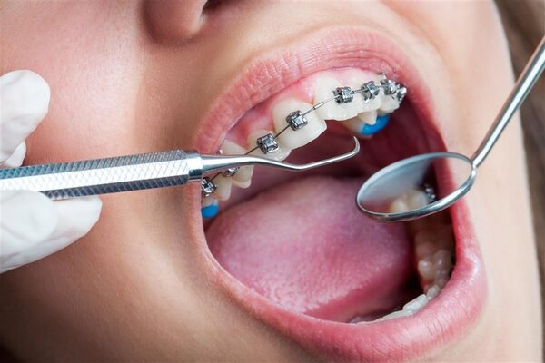 整牙是迅速提升颜值的“利器”？小心成变丑的“凶器”