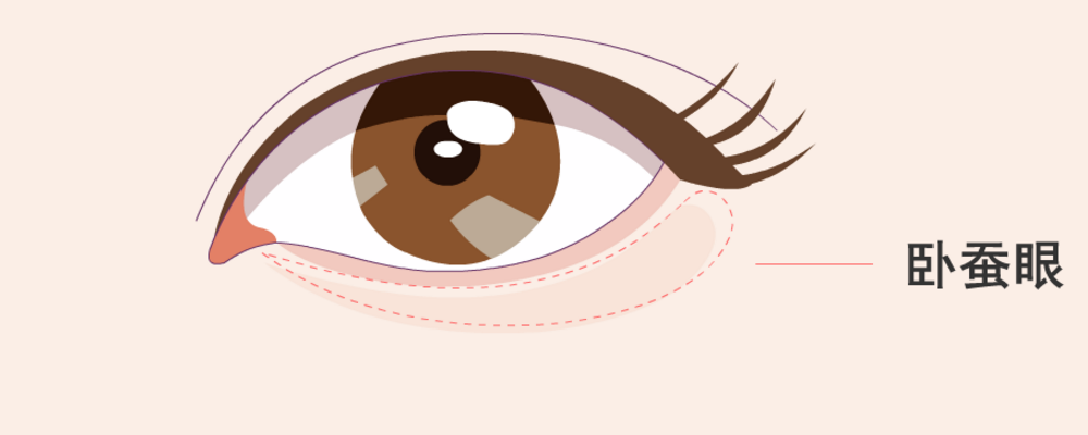 卧蚕和眼袋的区别是什么 如何去除眼袋 眼袋手术有风险吗