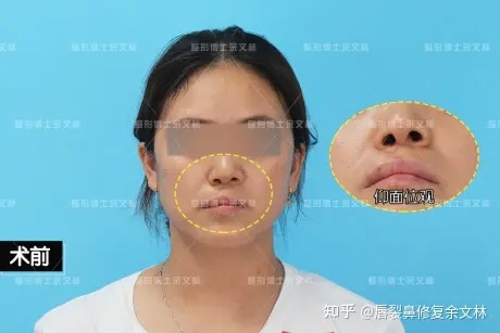 【余文林唇裂鼻案例分享】有鼻炎可以做唇裂鼻畸形矫正吗？