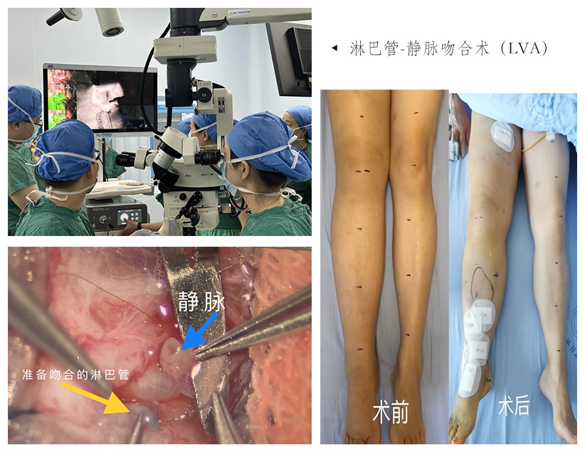 淋巴水肿超显微淋巴静脉吻合术日前在成都七院完成首例