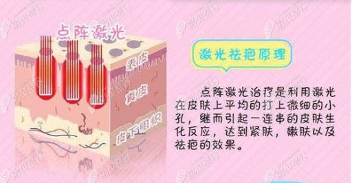 唇裂术后多久可以进行激光祛疤？余文林博士解答！