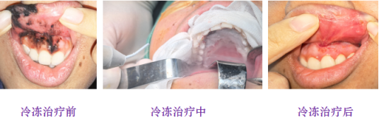 ��ǻ�ڰ߱���ӣ�������ǻ�Ĥ��ɫ�������������ǹؼ�